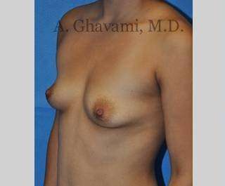 Breast Augmentation Before & After Patient #8946