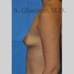Breast Augmentation Before & After Patient #8946
