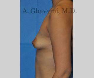 Breast Augmentation Before & After Patient #8946