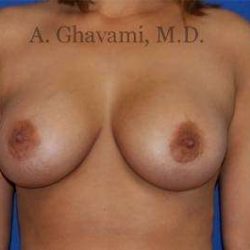 Breast Augmentation Before & After Patient #8939