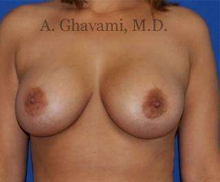 Breast Augmentation Before & After Patient #8939