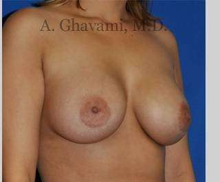 Breast Augmentation Before & After Patient #8939