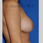 Breast Augmentation Before & After Patient #8939