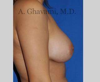 Breast Augmentation Before & After Patient #8939