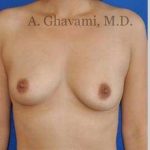 Breast Augmentation Before & After Patient #8939