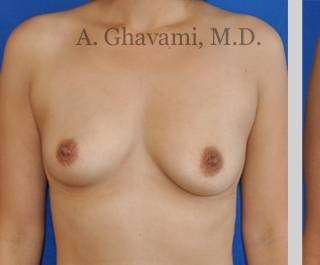 Breast Augmentation Before & After Patient #8939