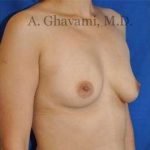 Breast Augmentation Before & After Patient #8939