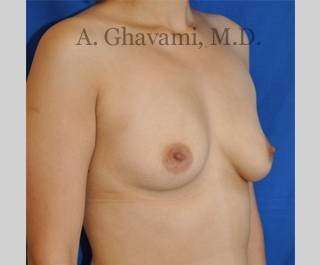 Breast Augmentation Before & After Patient #8939