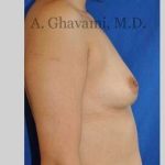 Breast Augmentation Before & After Patient #8939