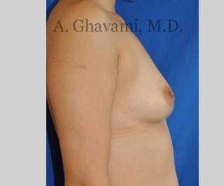 Breast Augmentation Before & After Patient #8939