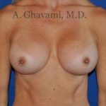 Breast Augmentation Before & After Patient #8932