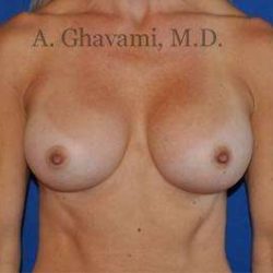 Breast Augmentation Before & After Patient #8932
