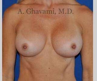 Breast Augmentation Before & After Patient #8932