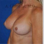 Breast Augmentation Before & After Patient #8932
