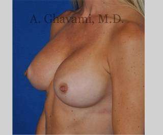 Breast Augmentation Before & After Patient #8932