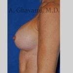 Breast Augmentation Before & After Patient #8932