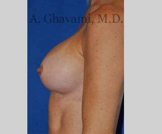 Breast Augmentation Before & After Patient #8932