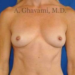 Breast Augmentation Before & After Patient #8932