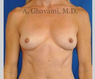 Breast Augmentation Before & After Patient #8932