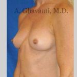 Breast Augmentation Before & After Patient #8932