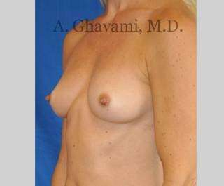 Breast Augmentation Before & After Patient #8932