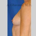Breast Augmentation Before & After Patient #8932