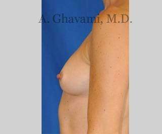 Breast Augmentation Before & After Patient #8932