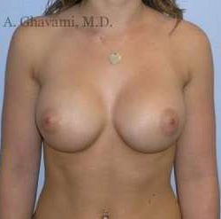Breast Augmentation Before & After Patient #8925