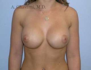 Breast Augmentation Before & After Patient #8925