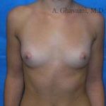 Breast Augmentation Before & After Patient #8925