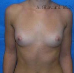 Breast Augmentation Before & After Patient #8925
