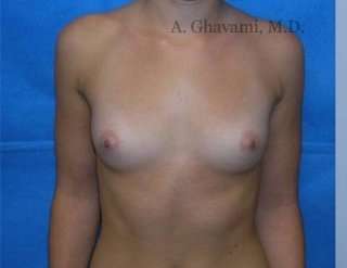Breast Augmentation Before & After Patient #8925