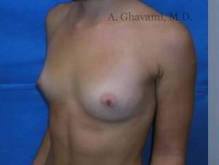 Breast Augmentation Before & After Patient #8925