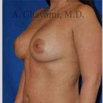 Breast Augmentation Before & After Patient #8920