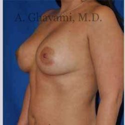 Breast Augmentation Before & After Patient #8920