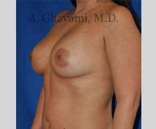 Breast Augmentation Before & After Patient #8920