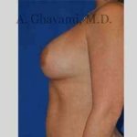 Breast Augmentation Before & After Patient #8920