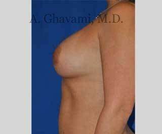 Breast Augmentation Before & After Patient #8920