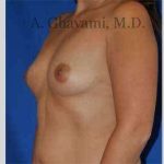 Breast Augmentation Before & After Patient #8920