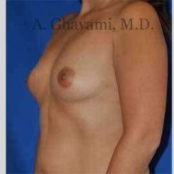 Breast Augmentation Before & After Patient #8920