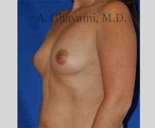 Breast Augmentation Before & After Patient #8920