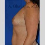 Breast Augmentation Before & After Patient #8920