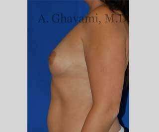 Breast Augmentation Before & After Patient #8920