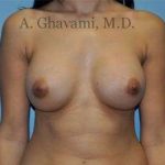 Breast Augmentation Before & After Patient #8915