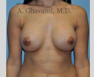 Breast Augmentation Before & After Patient #8915
