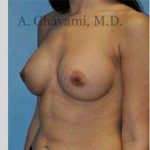 Breast Augmentation Before & After Patient #8915