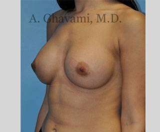 Breast Augmentation Before & After Patient #8915