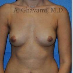 Breast Augmentation Before & After Patient #8915