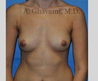 Breast Augmentation Before & After Patient #8915