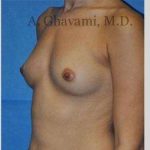Breast Augmentation Before & After Patient #8915